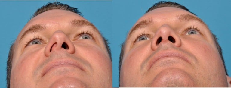 symptoms-of-a-deviated-septum_60c8a934039f6.jpeg