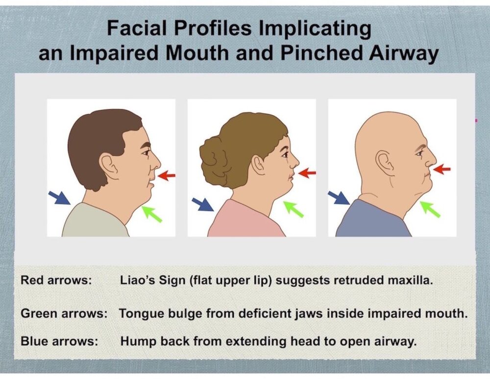 Facial profiles impaired mouth 1024x791