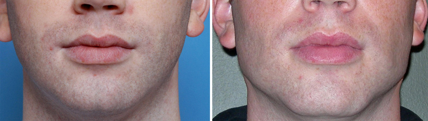 Square-Chin-Implant-result-front-view-Dr-Barry-Eppley-Indianapolis.jpg