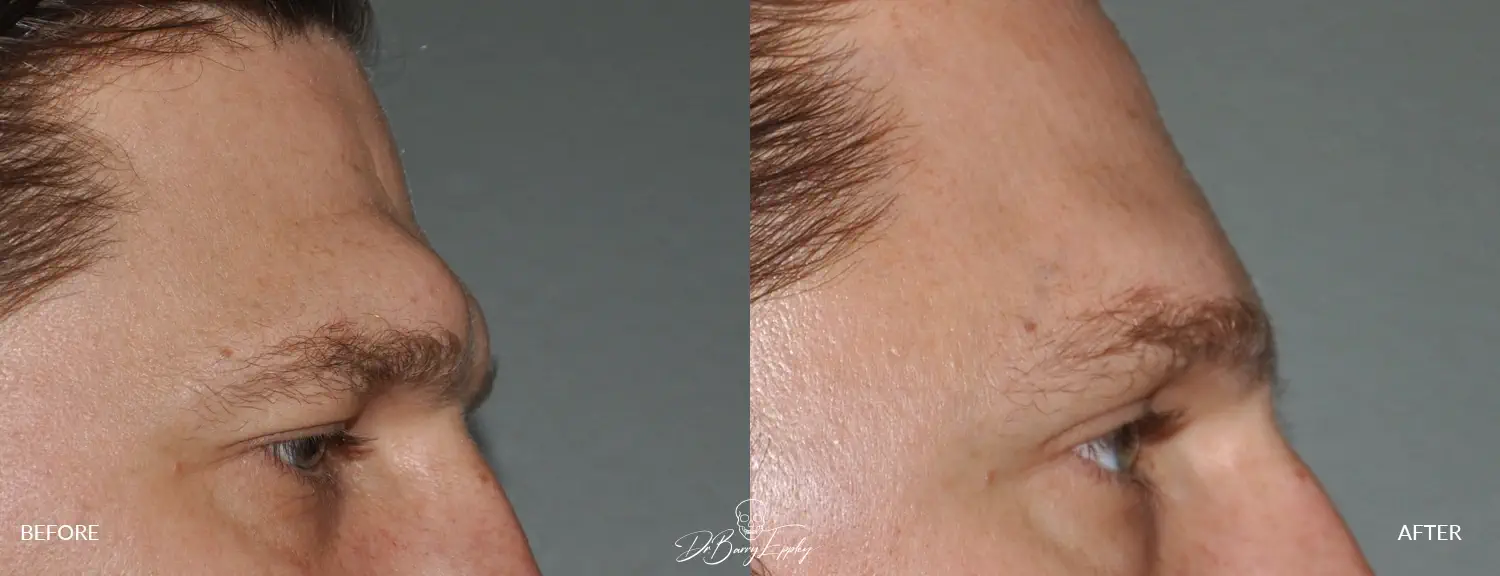 ba-male-brow-bone-reduction-3.webp