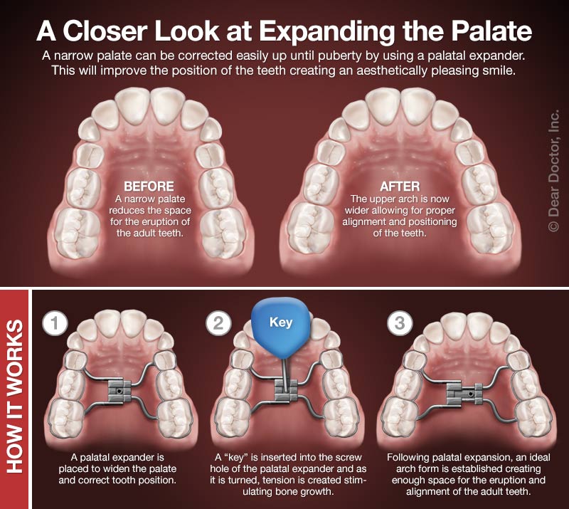 palatal-expanders.jpg