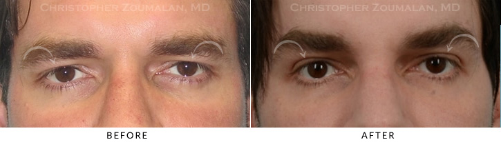 male-brow-lift-gal-3a.jpg
