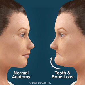 Bone Loss: the Hidden Consequence of Your Missing Teeth - Aesthetic Dental