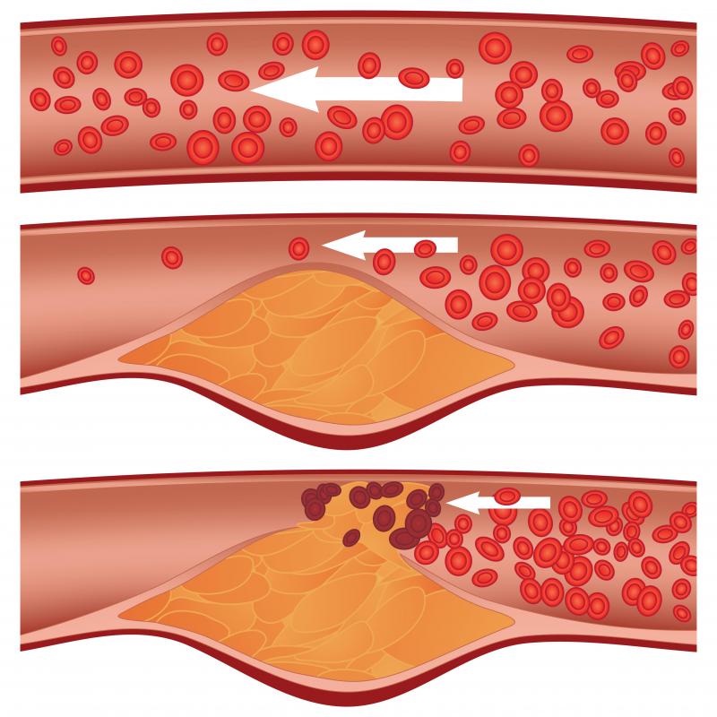 arteries-clear-and-clogged.jpg