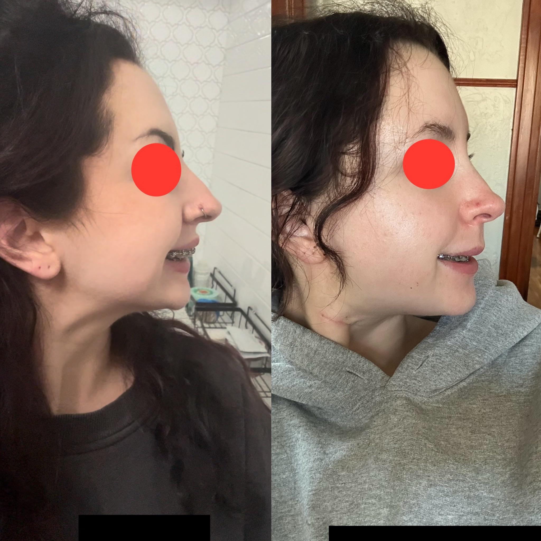 r/jawsurgery - 1 day pre-op bilateral TJR, Lefort vs 3 weeks post-op