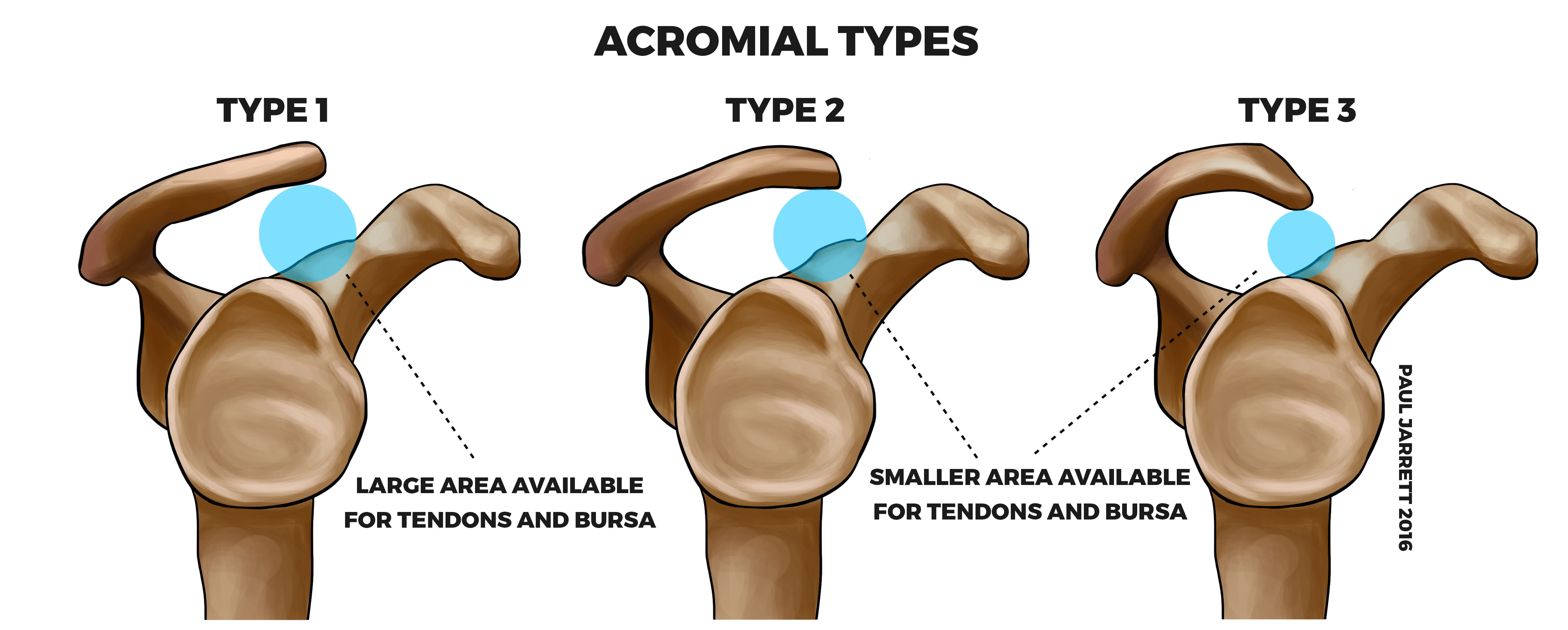 Acromial-Types.jpg