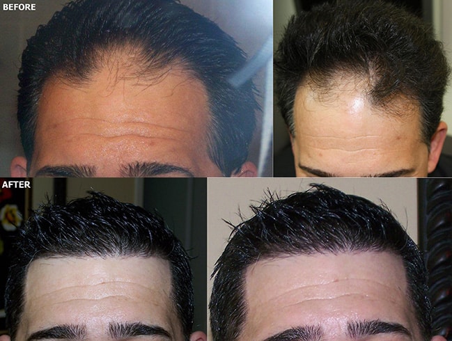 FUE Hairline Hair Restoration 2,970 Grafts - AlviArmani - Hair Transplant  Los Angeles