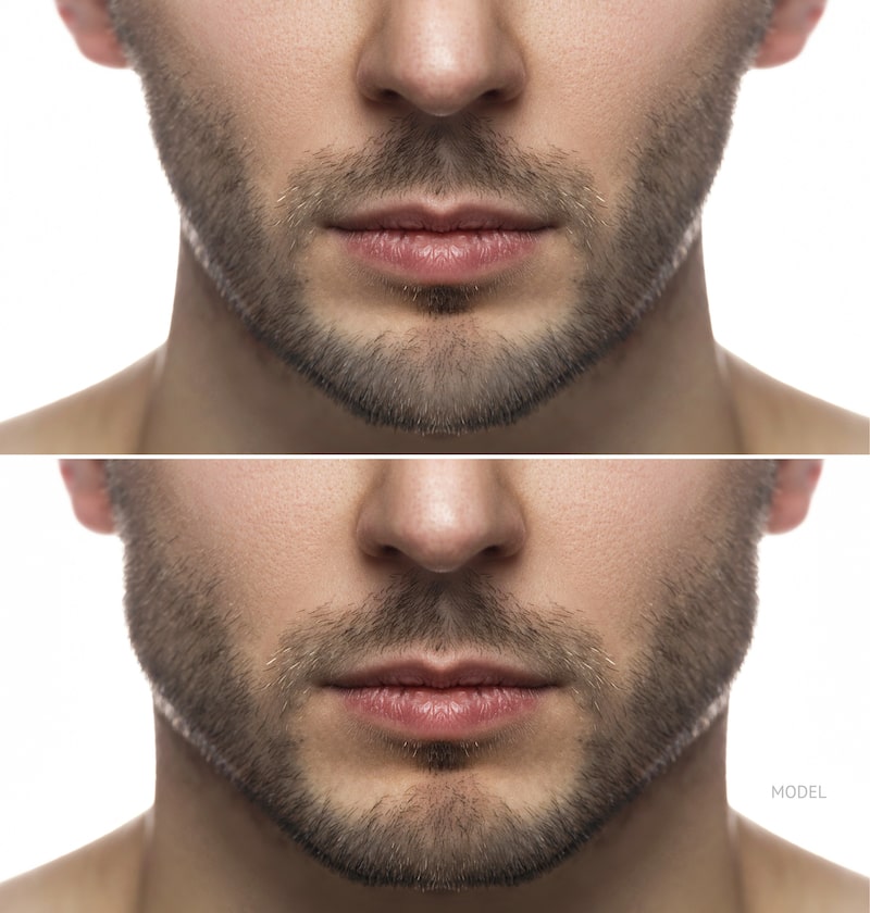 man-before-and-after-a-jaw-implant.jpg