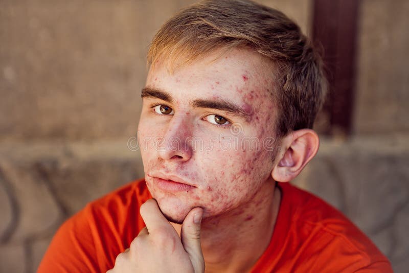 acne-young-man-has-problems-skin-77292905.jpg