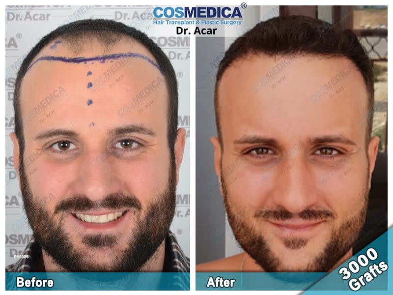 hair-transplant-before-after-3000-grafts-5.jpg