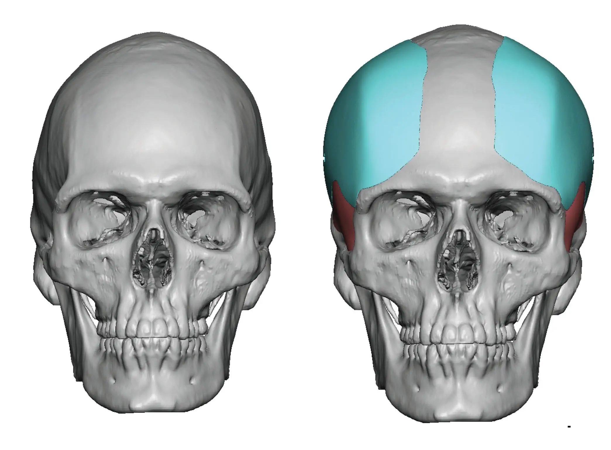 Male-Custom-Forehead-Temporal-Widening-Implants.webp