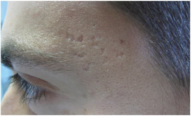 boxcar-acne-scars.jpg