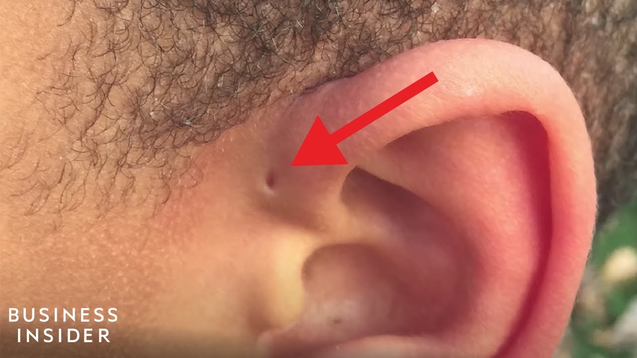 Explaining A Preauricular Sinus, A Tiny Hole Above Some People's Ears -  YouTube