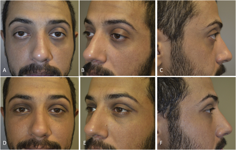 Combined orbital decompression and lower eyelid retraction surgery. -  Abstract - Europe PMC