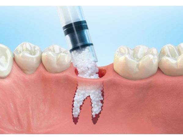 Parker-Dental-Group-Bone-Grafting.jpg