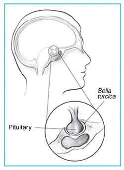 250px-Prolactinoma-art.jpg