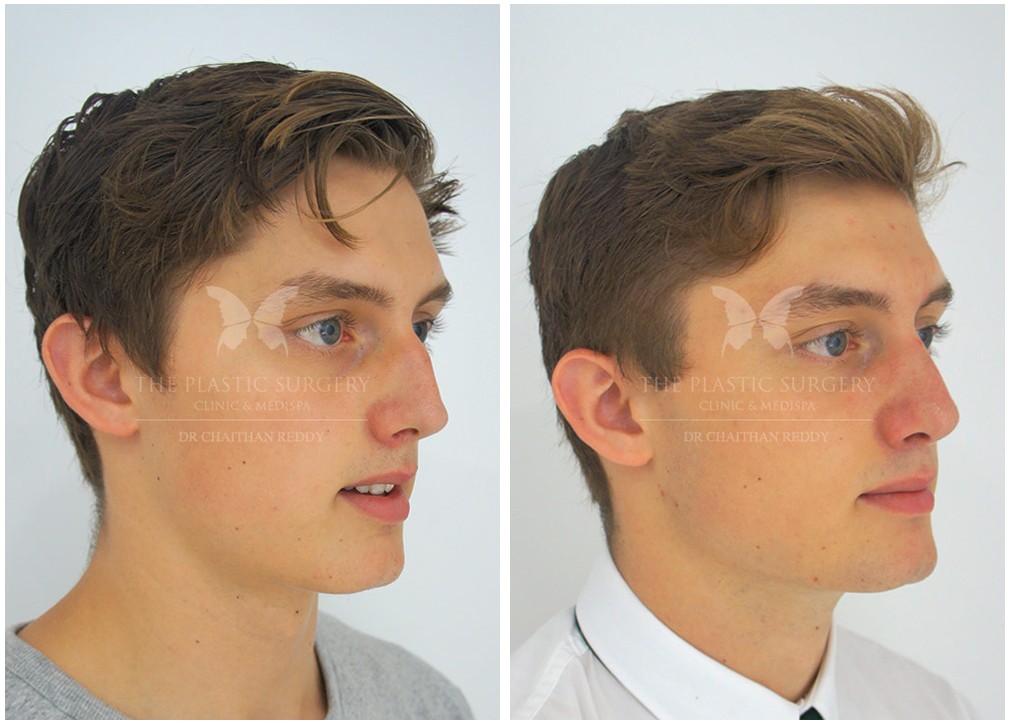 Rhinoplasty-053.jpg