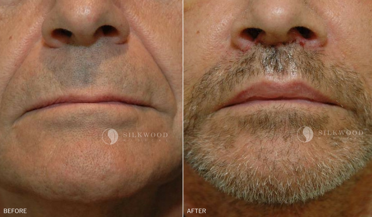 Lip Lift Sydney | Before and After Gallery | Dr Warwick Nettle