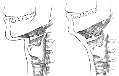 Bailey-hyoid-copy.jpg