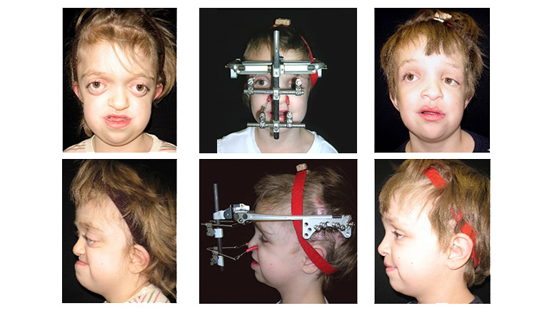 le-fort-iii-and-monobloc-advancement-treated-by-distraction-osteogenesis-craniofacial-surgical-management-revised-july-2017-780x439.jpg