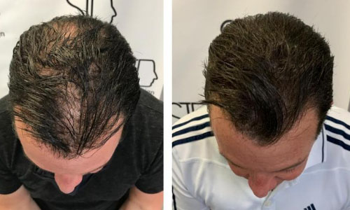 Scalp-Micropigmentation-Before-and-After-Add-Hair-Density-SID.jpg