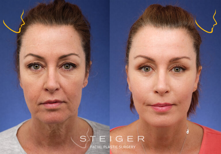facelift-insta-oct-768x534.jpg