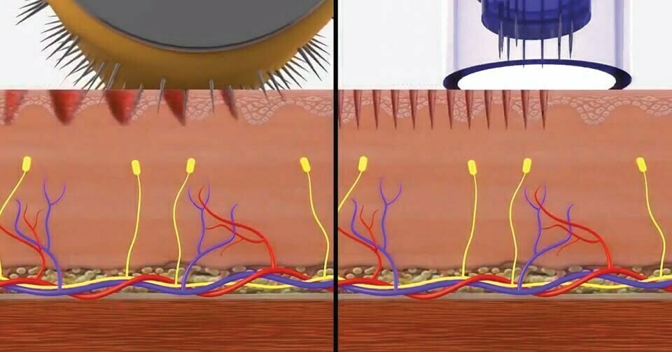 dermapen-illustration-960.jpg