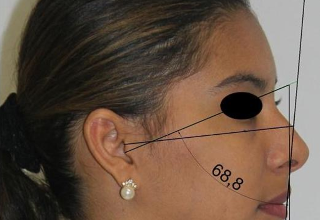 Assessment of the Relationship of the Frankfort Horizontal Plane ...