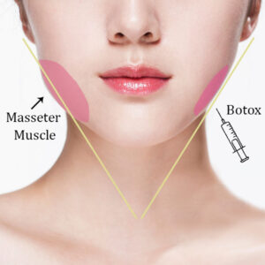 Botox-Masseter-Austin-3-300x300.jpg