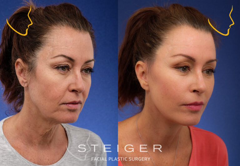 facelift-insta-oct-34-768x531.jpg