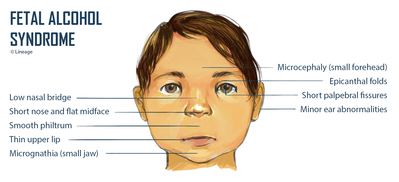 Bildergebnis für fetal alcohol syndrome