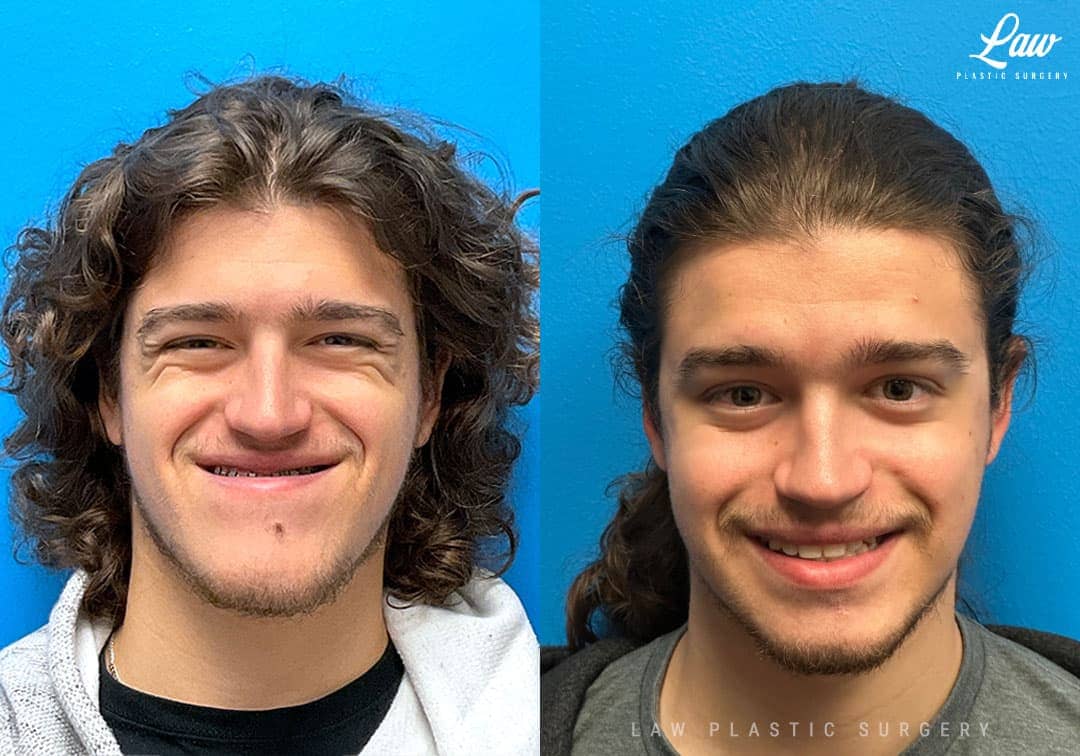 Jaw Surgery Before and After Photo. Surgery performed in Dallas, TX at Law Plastic Surgery.