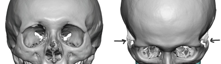 Posterior-Zygomatic-Arch-Osteotmies-3D-CT-scan-Dr-Barry-Eppley-Indianapolis-768x224.jpg
