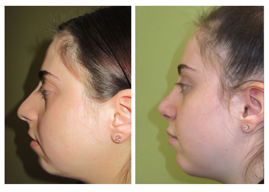 chin-implant.jpg