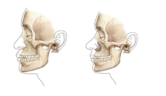 Image result for paranasal implant