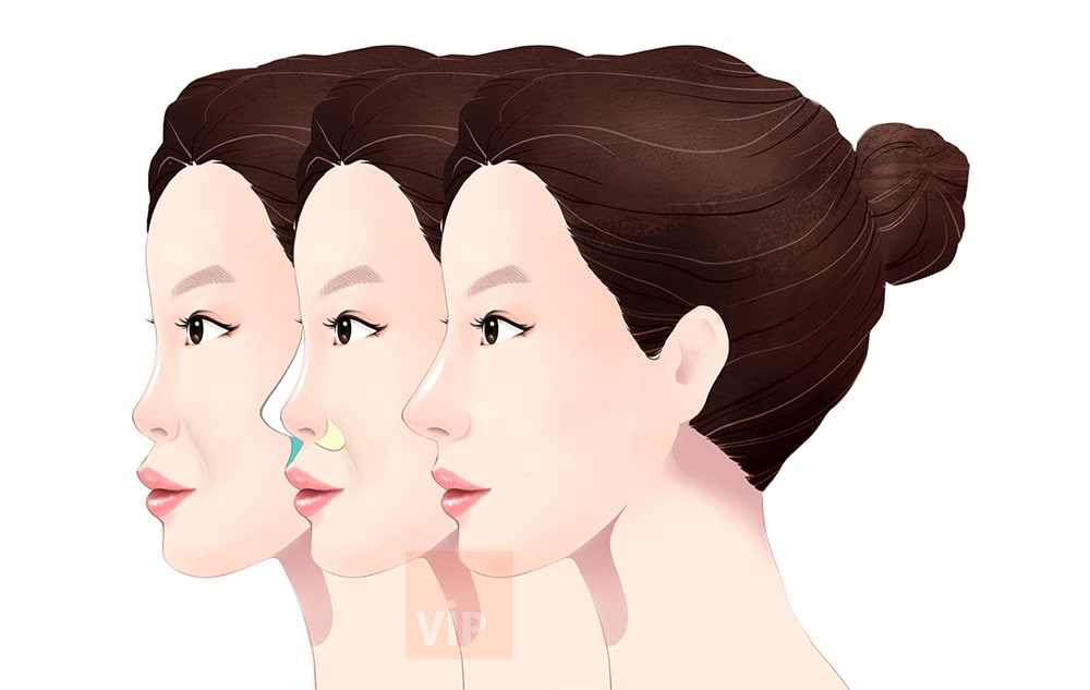 harmony-rhinoplasty-method.jpg