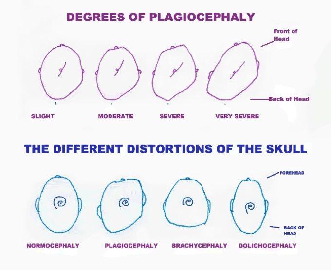 degrees-of-plagiocephaly.gif