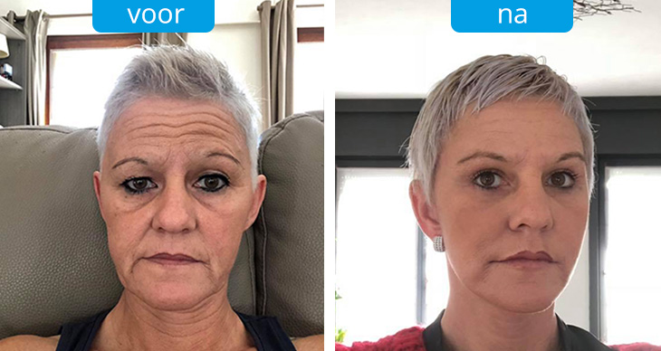 ba-facelift.jpg
