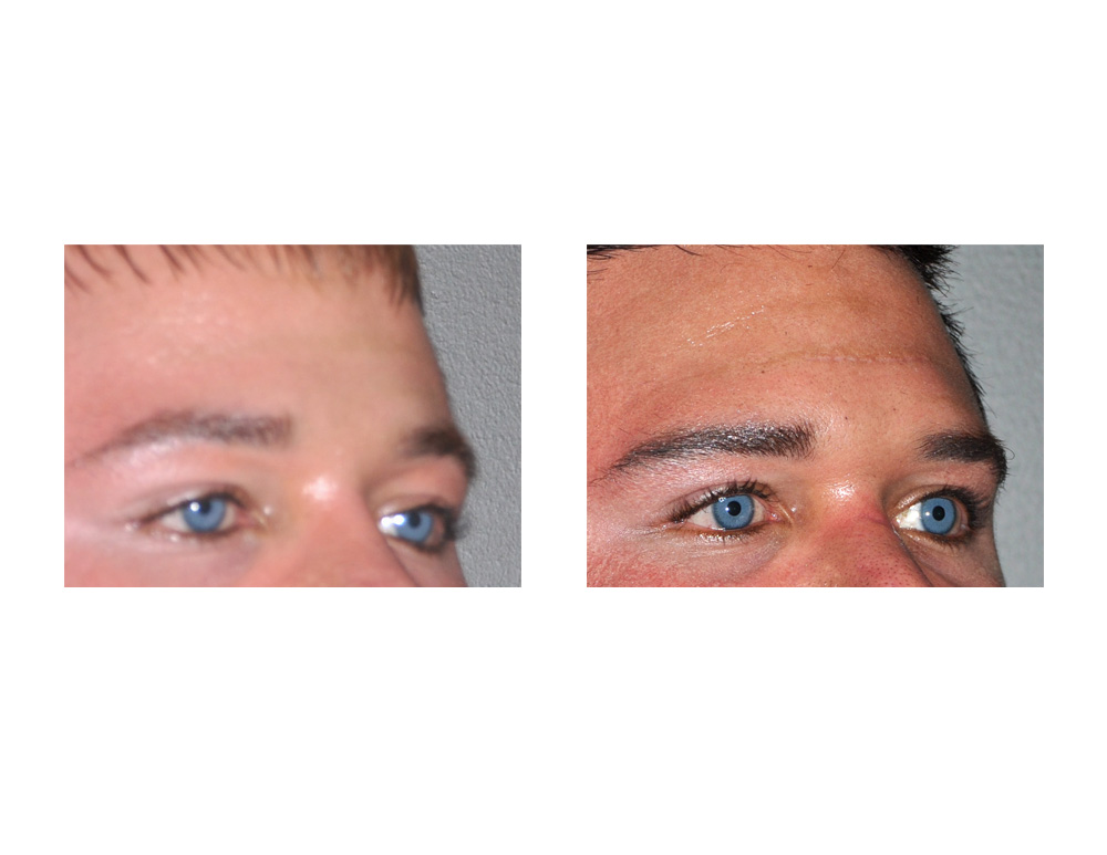 Brow-Bone-Implant-result-oblique-view-Dr-Barry-Eppley-Indianapolis.jpg