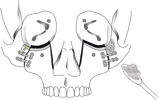 Technical Modifications for Intraoral Quadrangular Le Fort II Osteotomy -  ScienceDirect