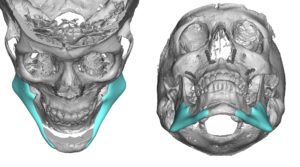 Sliding-Genioplasty-with-Custom-Jaw-Angle-Imlpants-design-front-views-Dr-Barry-Eppley-Indianaplis-300x167.jpg
