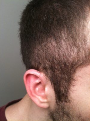 retrograde-alopecia-hair-transplant-mentor-1-300x400-1.jpg