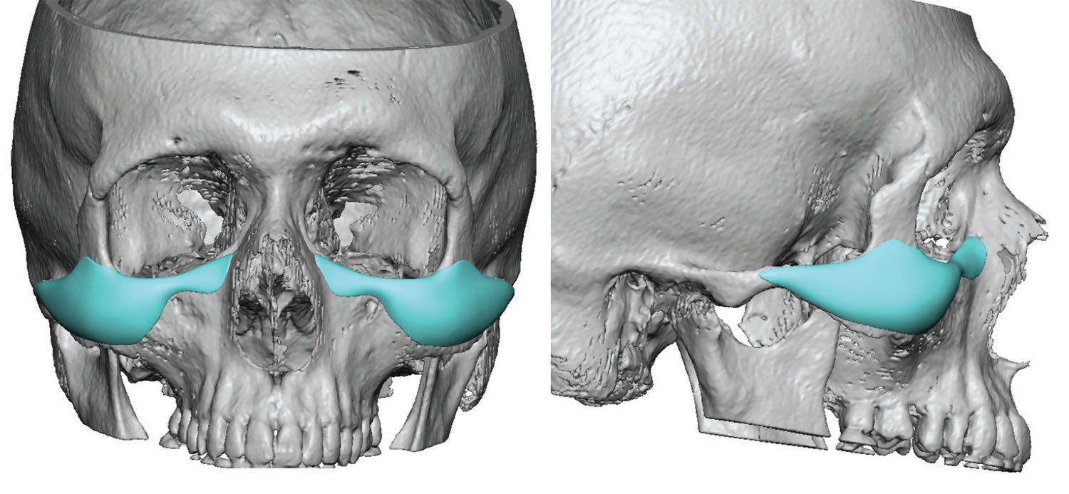 Custom-Infraorbital-Malar-Implants-Dr-Barry-Eppley-Indianapolis.jpg