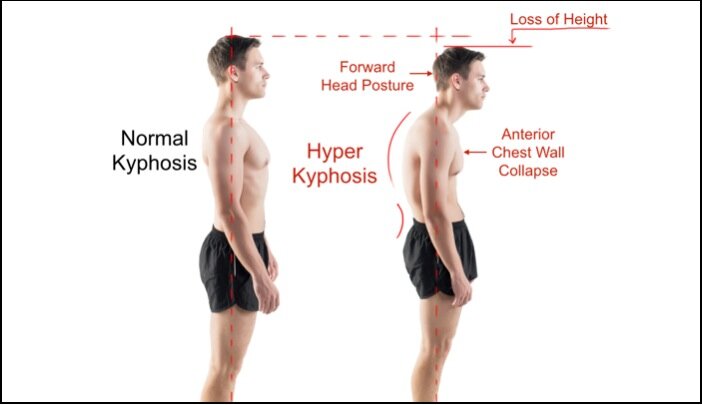 Kyphosis-Normal-vs-Hyper.jpg