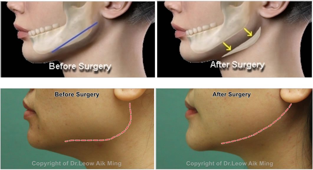 mandibular.jpg
