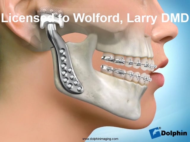 Total-Joint-Replacement-TMJ-Dr-Wolford-Maxillofacial-Jaw-Surgeon.jpg