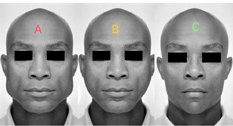 How to chew and get masseters like C instead of B? : r/orthotropics