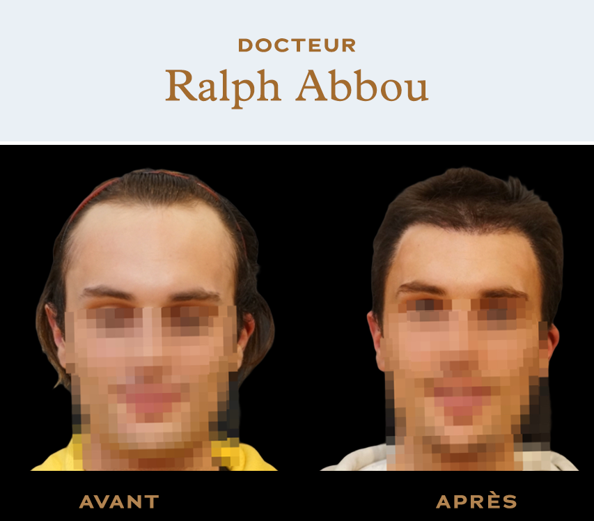 Before after Forehead reduction surgery paris - Dr Ralph Abbou