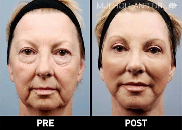 image1_surgical_facial-fat-transfer.jpg