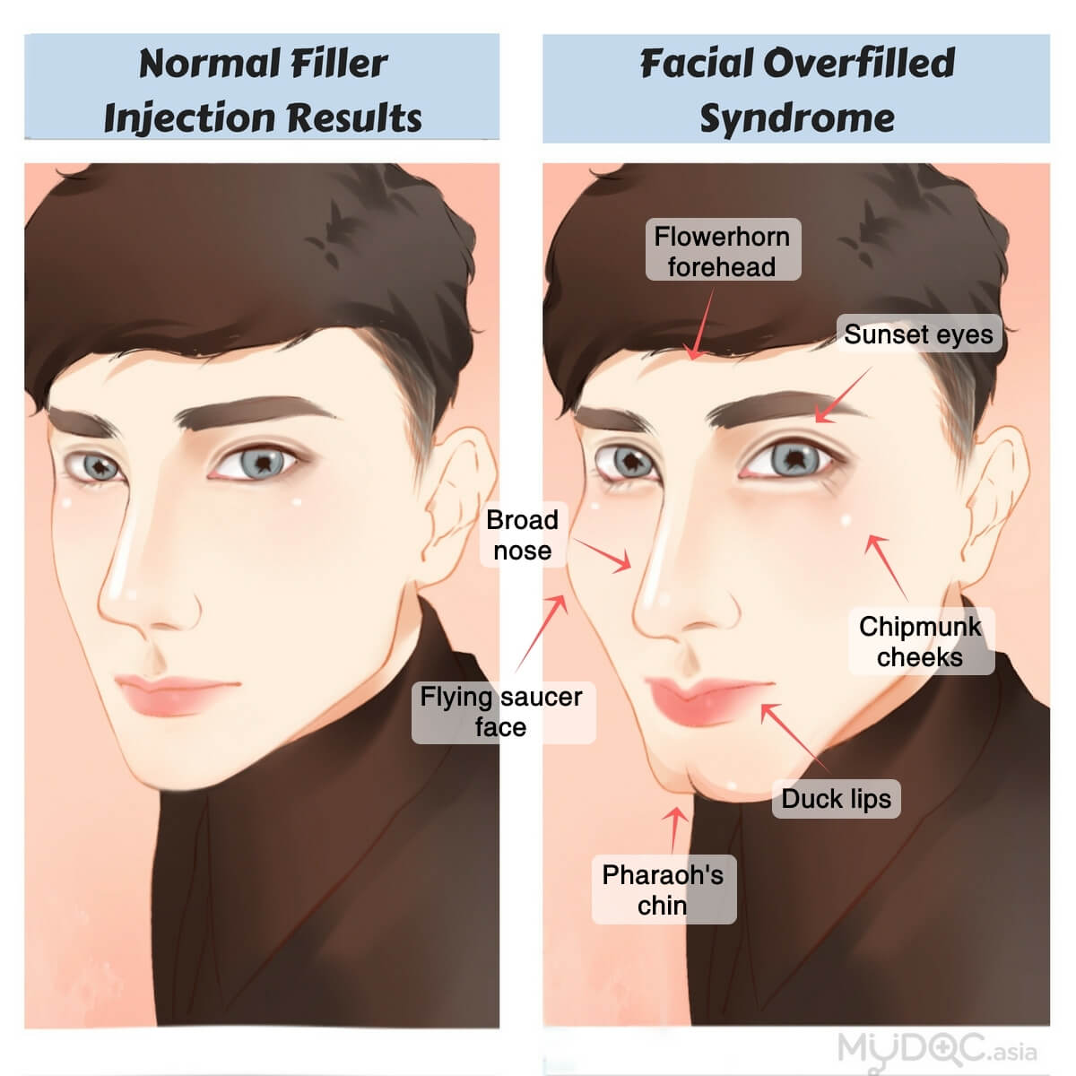 overfilled-syndrome-men-comparison-en-mydoctiny.jpg